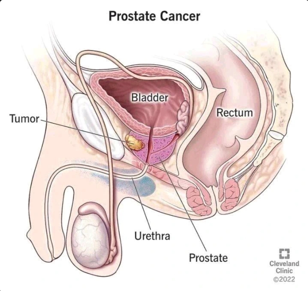What Men Should Do To Reduce The Risk Of Prostrate Enlargement As They Grow Older