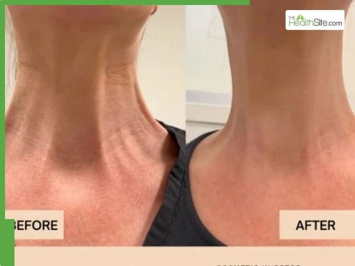 How Can You Remove Neck Lines Naturally and Tighten Sagging Skin? 4 Simple Exercises That Work.