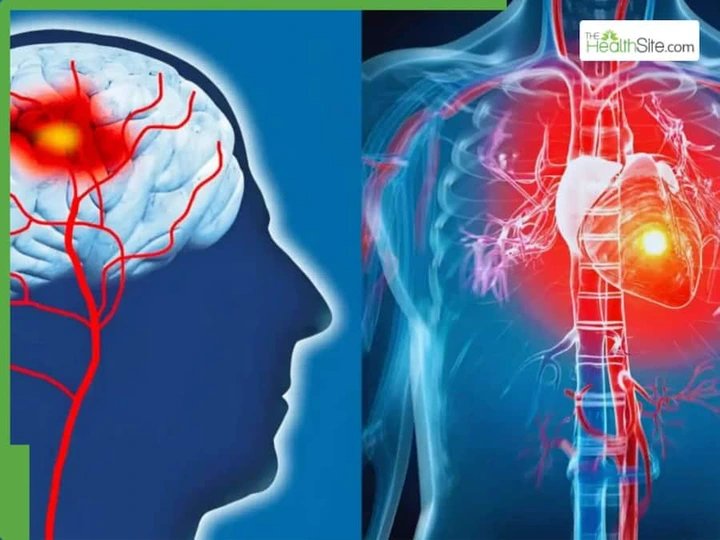 Stroke Vs Heart Attack: What Is The Difference And Which Is Deadlier?