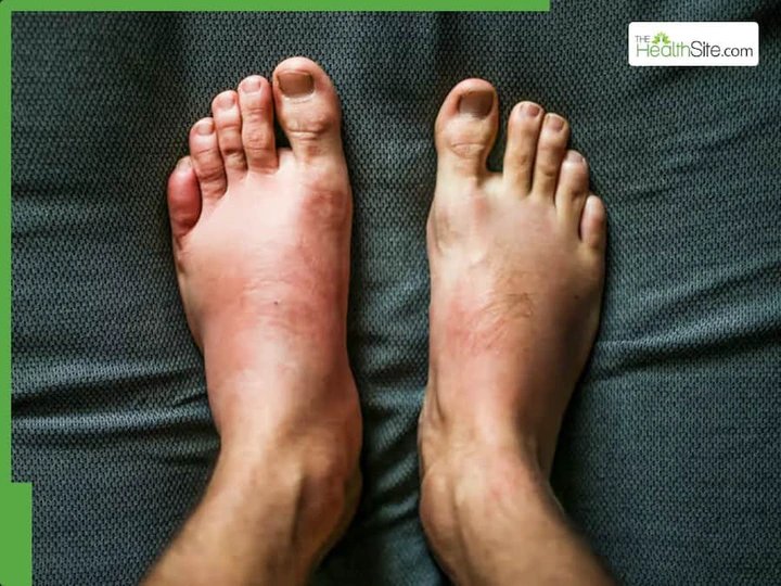 Kidney Failure Symptoms In Legs and Feet: 5 Warning Signs Your Kidneys Are Completely Damaged