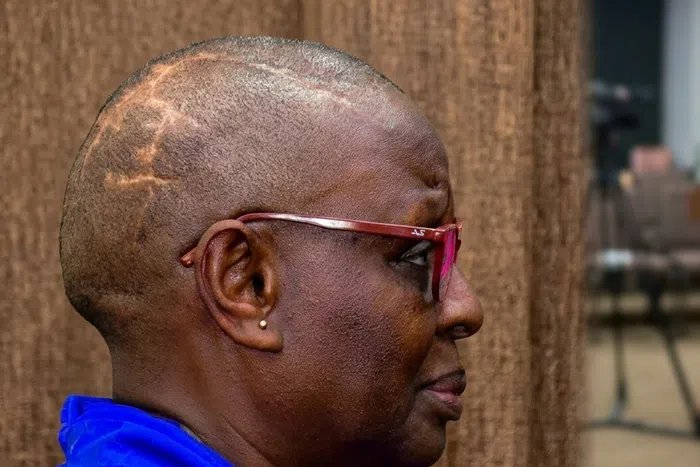 Molly Katanga displays scars from alleged late husband’s attack