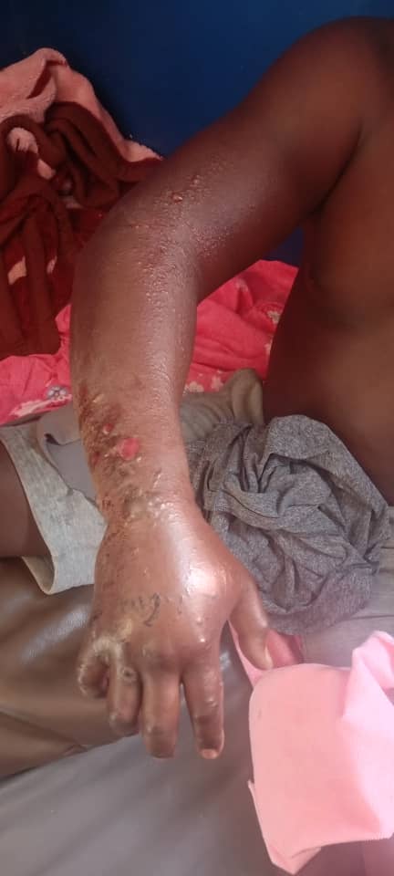 Anthrax Outbreak Confirmed in Kitagwenda as Three Test Positive