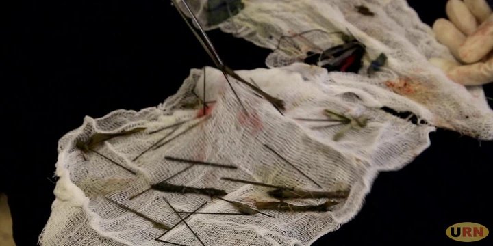 Surgeons Took 8 Hours to Extract 50 Needles plus Broken Pens inside Tortured Boy’s Stomach